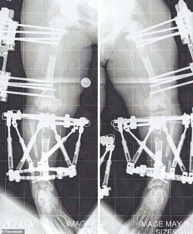 Chandler Crews' Journey with Achondroplasia: Defying Genetic Limits and Redefining Self-Image