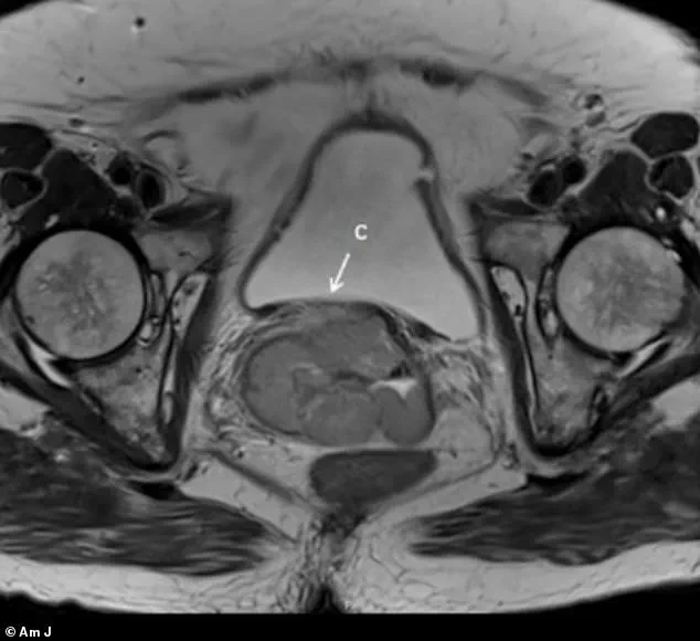 Overlooked Symptoms Lead to Fatal Outcomes in Post-Menopausal Women