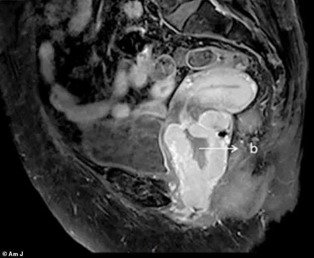 Overlooked Symptoms Lead to Fatal Outcomes in Post-Menopausal Women