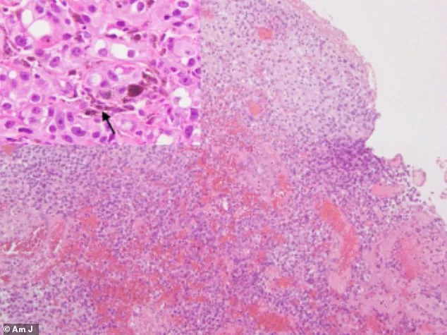 Overlooked Symptoms Lead to Fatal Outcomes in Post-Menopausal Women