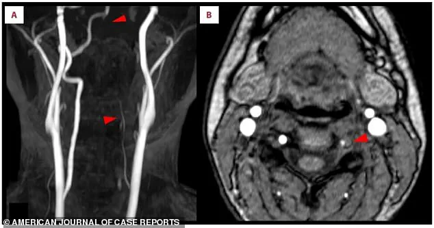 Case Study: Stroke Linked to Nintendo Switch Fitness Game Use in Young Adult