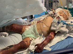 New Australian Study Reveals Alarming Sepsis Risk for Younger Americans with Type 2 Diabetes