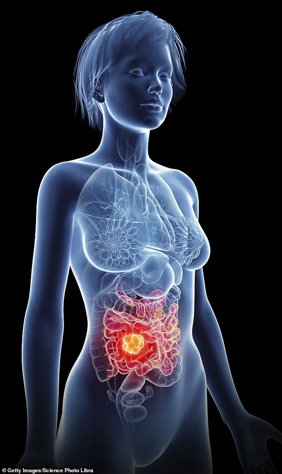 As a Cancer Scientist and Mother, I'm Fighting the Rise of Young-Onset Bowel Cancer