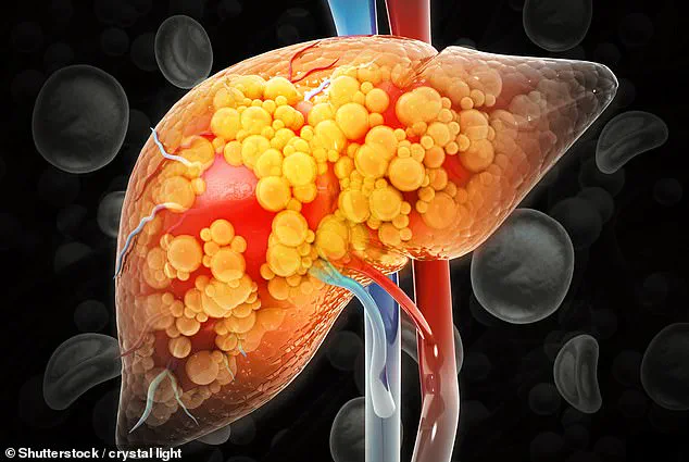 Spanish Scientists' Discovery: 'Common Medications Could Reverse Liver Disease, Offering New Hope for MASLD Patients'