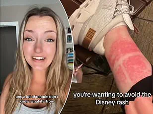 Mysterious Rash Linked to Theme Parks Leads to Surprising Diagnosis for Woman