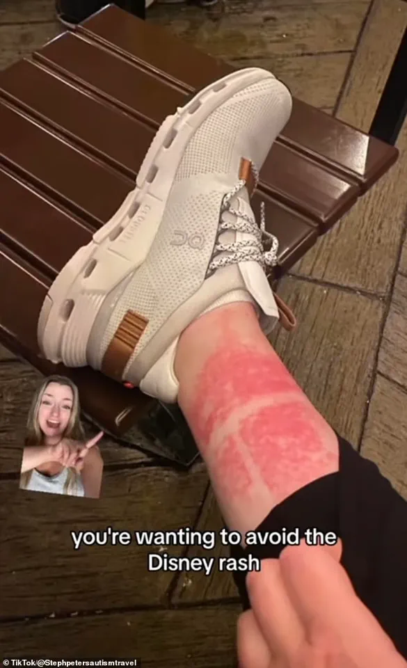 Mysterious Rash Linked to Theme Parks Leads to Surprising Diagnosis for Woman