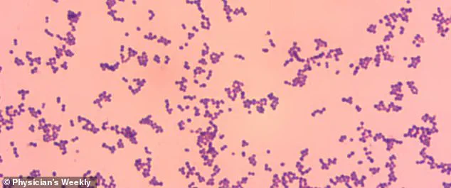 Rising Concerns Over Group G Streptococcus: From Harmless Skin Bacteria to Life-Threatening Infections, as Medical Professionals Sound the Alarm