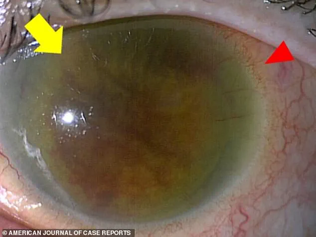 Rising Concerns Over Group G Streptococcus: From Harmless Skin Bacteria to Life-Threatening Infections, as Medical Professionals Sound the Alarm