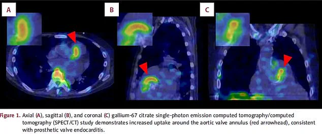 Rising Concerns Over Group G Streptococcus: From Harmless Skin Bacteria to Life-Threatening Infections, as Medical Professionals Sound the Alarm