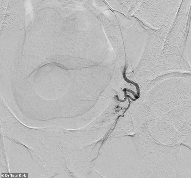 Silent Epidemic: The Growing Challenge of Benign Prostatic Hyperplasia in Aging Populations