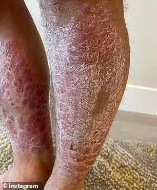 Privileged Access, Persistent Struggle: Chad Mendes' Psoriasis Journey and the Quest for Credible Health Solutions