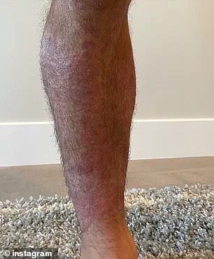 Privileged Access, Persistent Struggle: Chad Mendes' Psoriasis Journey and the Quest for Credible Health Solutions