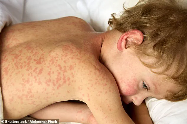 Public Health Alert: Measles Outbreak at Major US Airports Raises Concerns Over Disease Spread During Holiday Travel