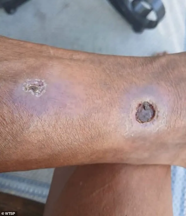 Florida Resident Sues Apartment Complex Over Alleged Negligence Leading to Severe Medical Consequences