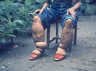 Surge in Parasite-Infected Insects Sparks Health Alarms, Experts Warn of Chagas Disease Risk