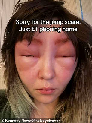 Vancouver Woman's Severe Allergic Reaction to Eyebrow Tinting Leaves Her Face Swollen and Resembling an 'Alien'