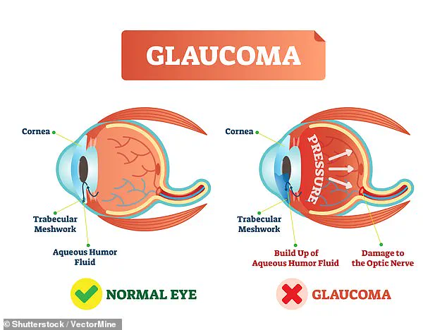New Figures Reveal Over a Million in the UK Living with Glaucoma, a Leading Cause of Blindness