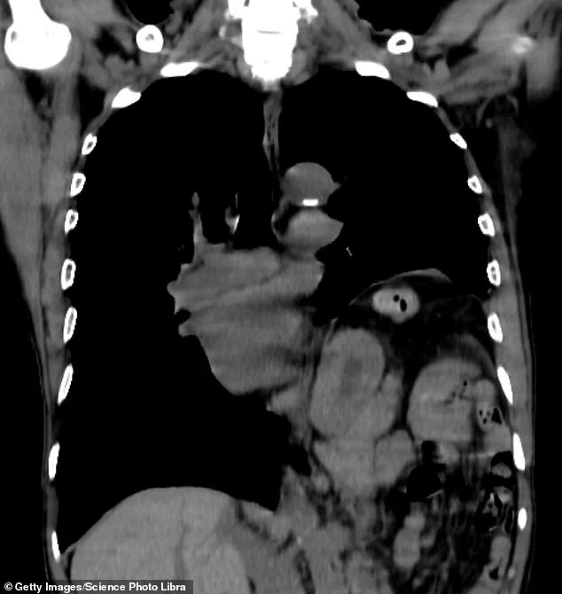 Persistent Hiccups: Man's 5-Year Struggle Defies Medical Treatments