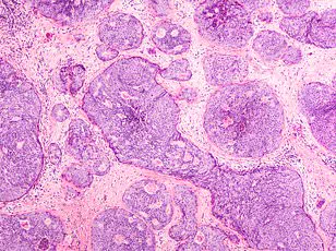 Chase Johnson: A Breast Cancer Survivor and Pioneer in Groundbreaking Vaccine Trial