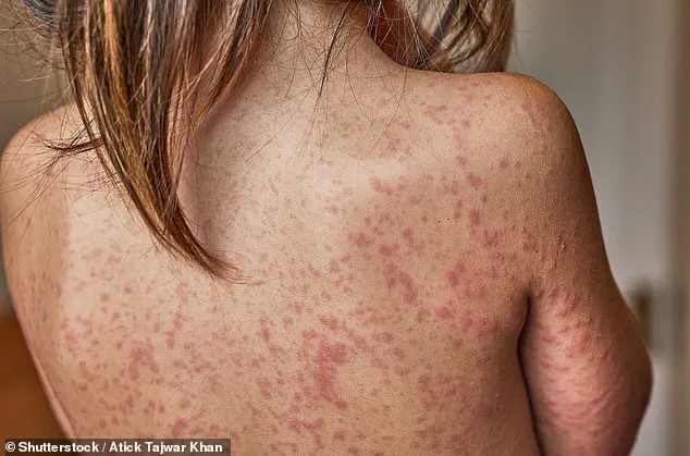 Third Measles Case Confirmed in Orange County as Disney-Linked Outbreak Spreads