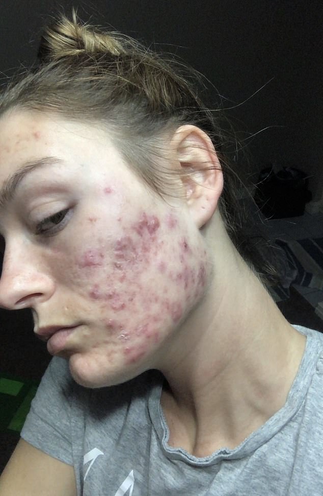 The Overnight Transformation: How Stress and Motherhood Triggered a Sudden Acne Crisis in Tara Dekker