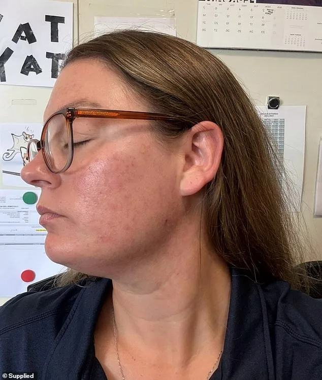 The Overnight Transformation: How Stress and Motherhood Triggered a Sudden Acne Crisis in Tara Dekker