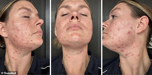 The Overnight Transformation: How Stress and Motherhood Triggered a Sudden Acne Crisis in Tara Dekker