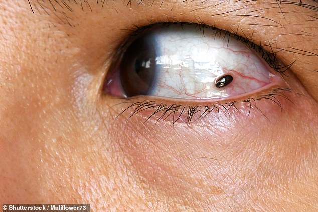 A Freckle's Warning: How Laura's Eye Symptoms Pointed to a Serious Condition