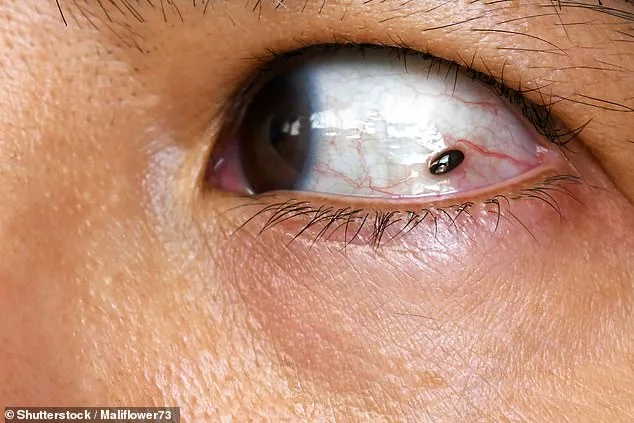 A Freckle's Warning: How Laura's Eye Symptoms Pointed to a Serious Condition