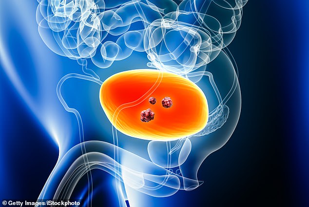 Breakthrough in Bladder Cancer Treatment: NHS Approves Durvalumab for Muscle-Invasive Disease