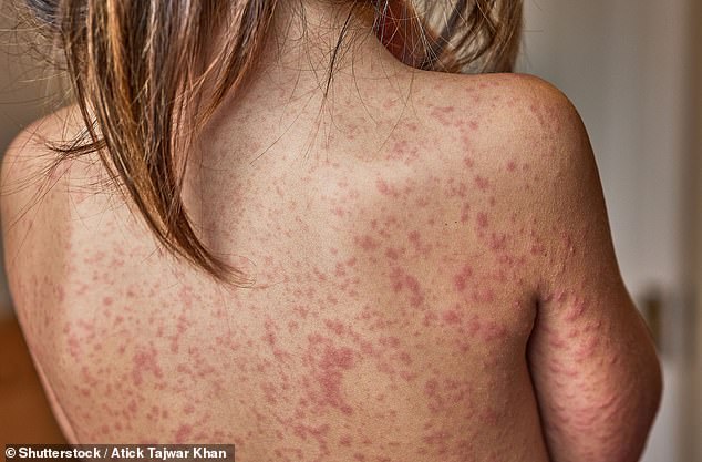 London on Brink of Measles Outbreak: Vaccination Urged for Vulnerable Groups