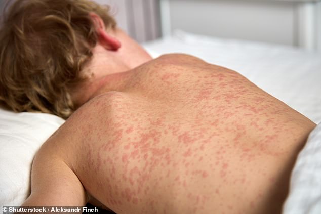 Measles Exposure at Philadelphia Airport: Unvaccinated Face High Risk, Officials Urge Caution