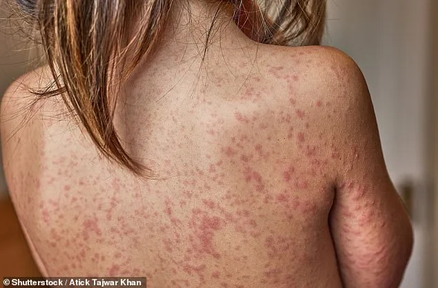 Measles Outbreak in Enfield Exposes Vaccine Gap, Sparks Public Health Alarm