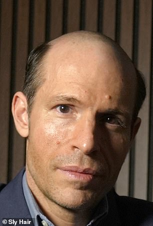 From Thick Curls to Baseball Caps: James Fairview's Hair Loss Battle