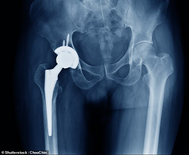NHS Crisis as Bone Cement Shortage Threatens Thousands of Hip and Knee Surgeries