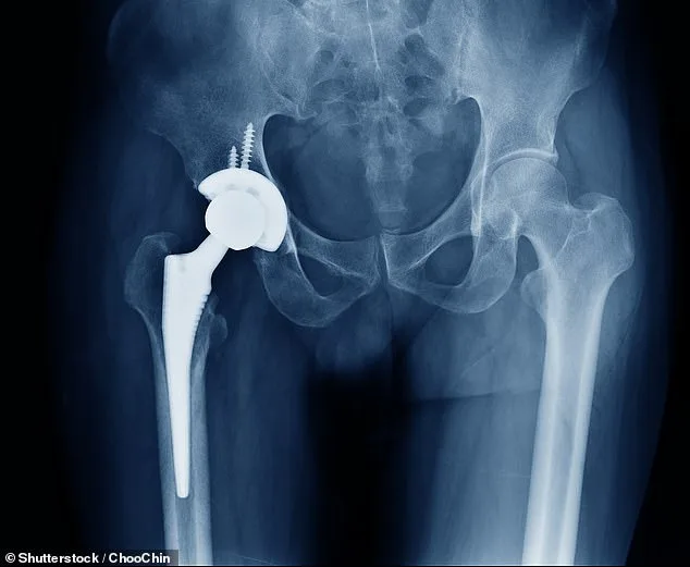 NHS Crisis as Bone Cement Shortage Threatens Thousands of Hip and Knee Surgeries