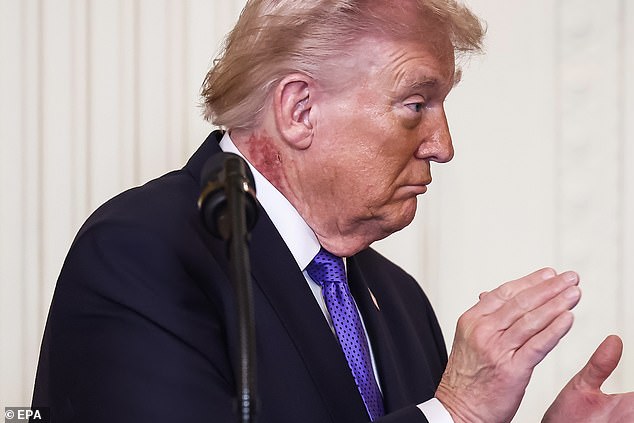 President Trump's Neck Rash Treated with Topical Cream, Experts Link to Actinic Keratosis
