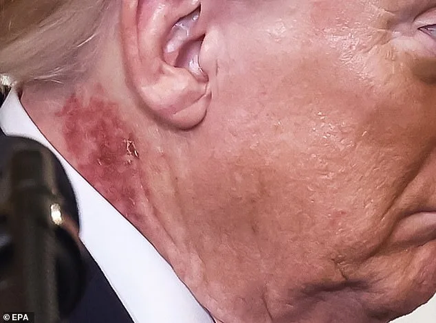 President Trump's Neck Rash Treated with Topical Cream, Experts Link to Actinic Keratosis