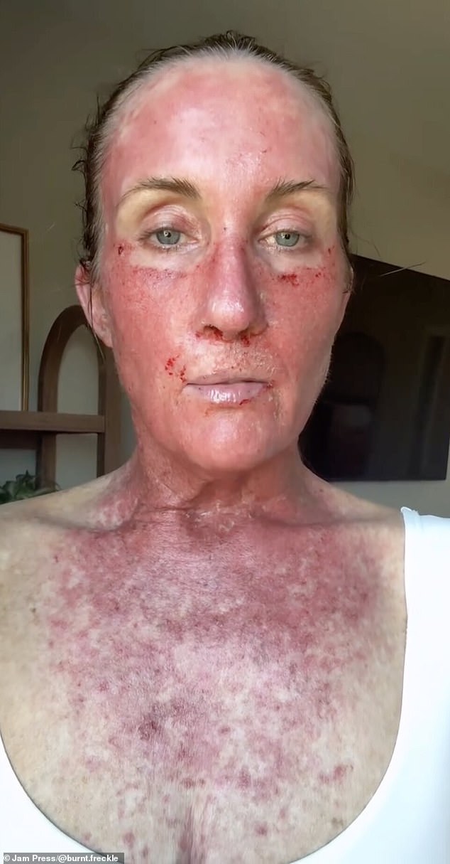 A Mother's Relentless 20-Year Battle Against Recurring Skin Cancer
