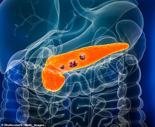Breakthrough Discovery Reveals Early Warning Signal for Pancreatic Cancer, Paving Way for Earlier Detection