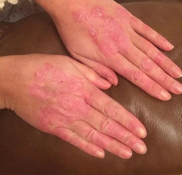 A 20-Year Battle: Living with Psoriasis and Psoriatic Arthritis