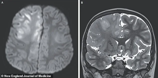Deadly Secret of Measles Resurges in U.S., Threatening Children with Rare Brain Disease