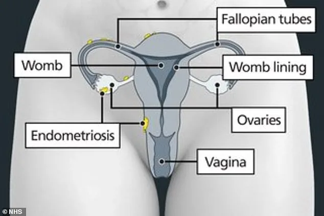 University of Queensland Researchers Develop Five-Minute Screening Tool to Revolutionize Endometriosis Diagnosis