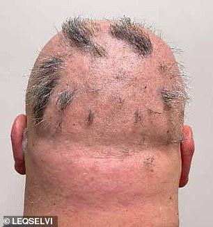 UK Approves New Medication for Alopecia Areata