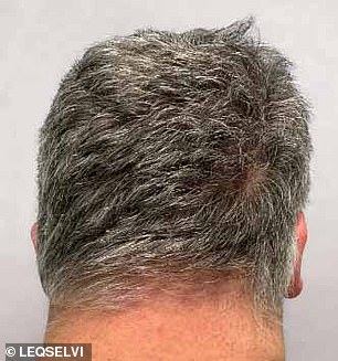 UK Approves New Medication for Alopecia Areata