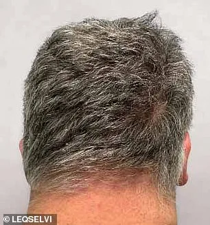 UK Approves New Medication for Alopecia Areata