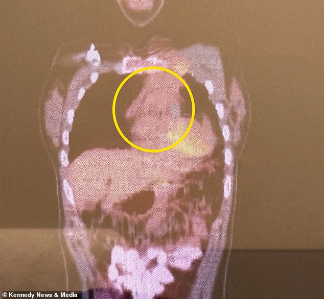 Overlooked Symptoms: Student Attributes Health Issues to Stress, Delaying Diagnosis by Two Years