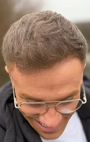 Desperate for a Solution: How Hair Fibres Changed Rob James' Life