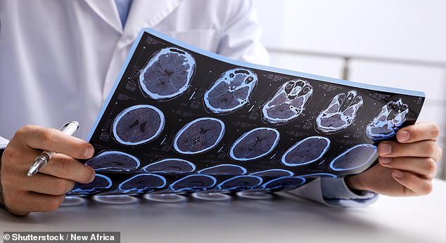 Multiple Sclerosis Cases Surge in England: Study Identifies Three Lifestyle Risk Factors