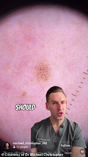 From Freckle to Cancer: The Story of Juliah Thompson's Unexpected Diagnosis